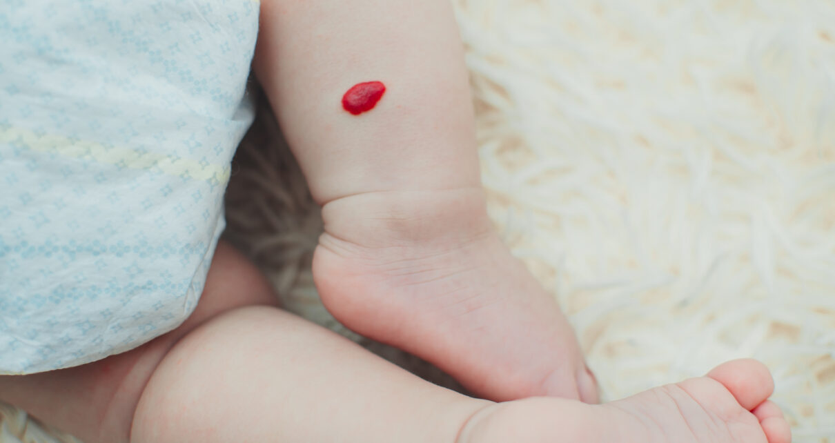 Naczyniaki a malformacje naczyniowe u dzieci – jak wygląda ich leczenie?